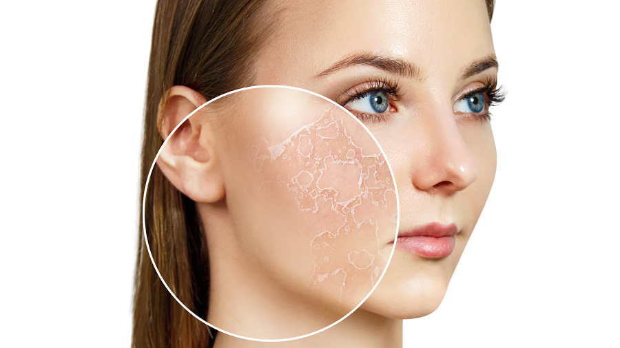 روش‌های درمان خشکی پوست بعد از لیزر